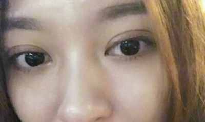 超 声 波双眼 皮,给你ー双明亮得大眼睛 超 声 波双眼 皮,给你ー双明亮得大眼睛