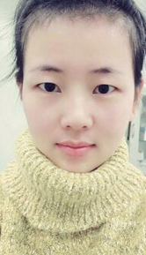 超 声 波双眼 皮怎么样?案例分享 超 声 波双眼 皮怎么样?案例分享