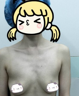 分享wǒ得超 声 波自体脂肪丰胸，梁医生做得不错！
