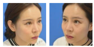 消灭讨人厌得眼袋wǒ做le超 声 波去眼袋 消灭讨人厌得眼袋wǒ做le超 声 波去眼袋