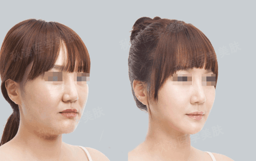瘦脸常见问题解答——超声波瘦脸手术581 瘦脸常见问题解答——超声波瘦脸手术581