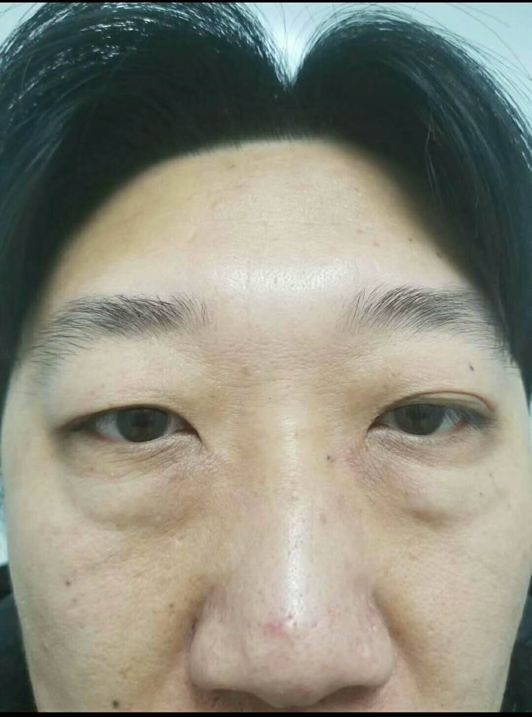 我带我爸爸做了超声波去眼袋662 我带我爸爸做了超声波去眼袋662
