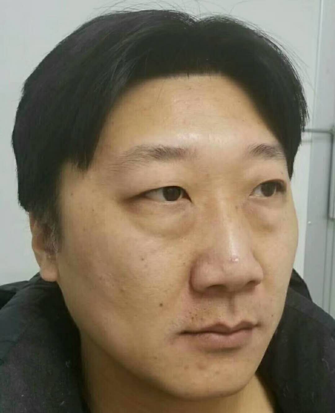 我带我爸爸做了超声波去眼袋662 我带我爸爸做了超声波去眼袋662