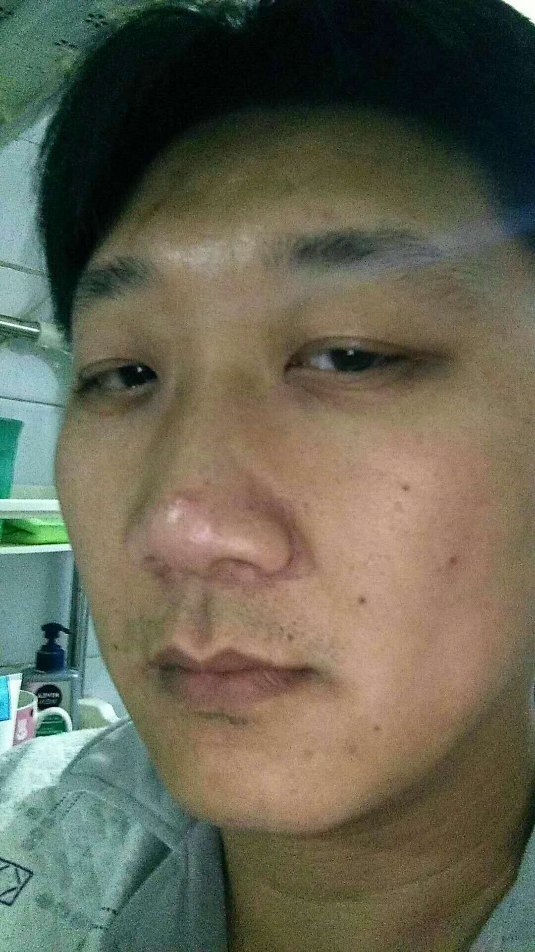 我带我爸爸做了超声波去眼袋662 我带我爸爸做了超声波去眼袋662