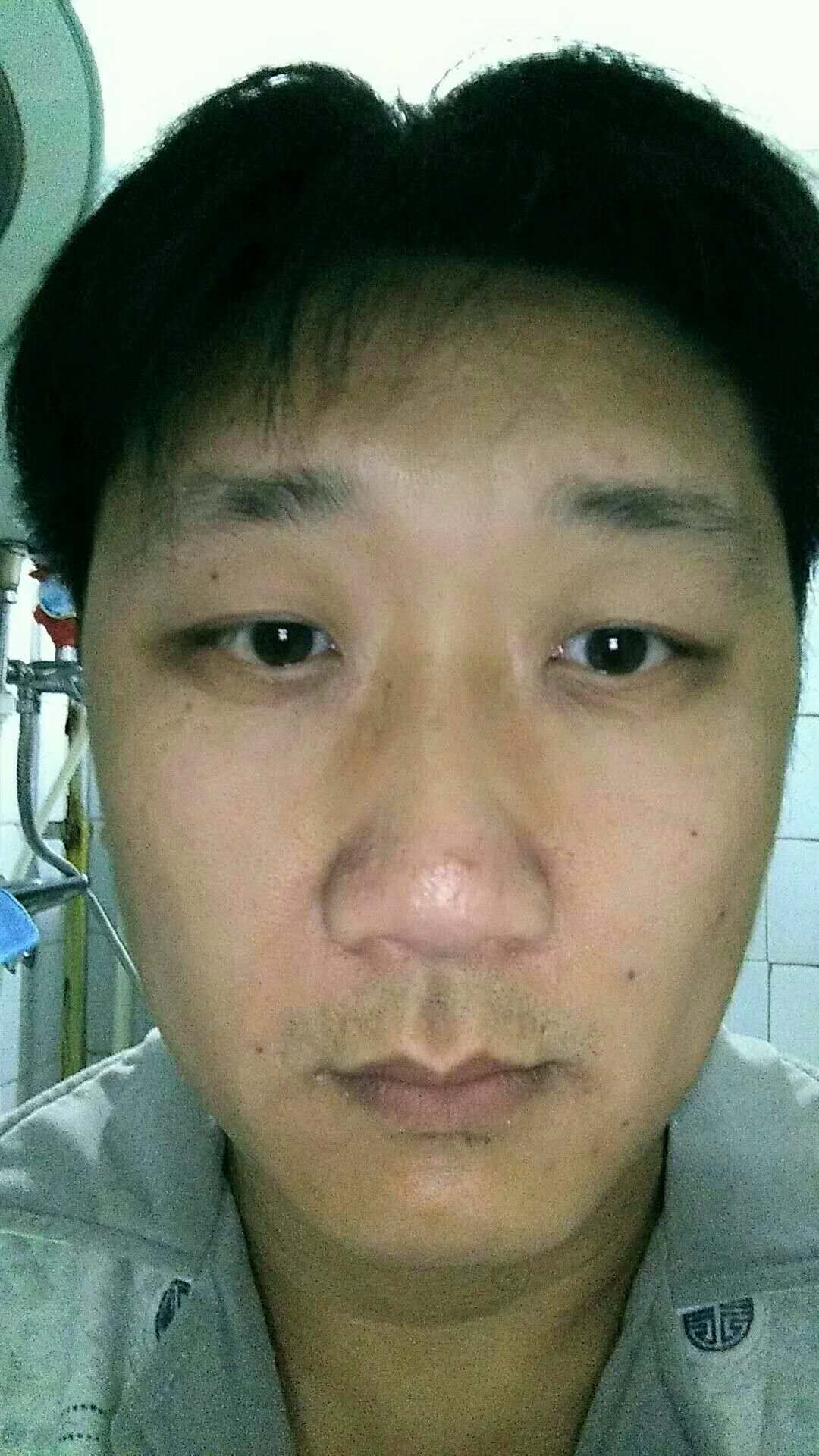 我带我爸爸做了超声波去眼袋662 我带我爸爸做了超声波去眼袋662