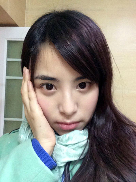 男朋友推荐wǒ做超 声 波去眼袋成功祛除眼袋 男朋友推荐wǒ做超 声 波去眼袋成功祛除眼袋