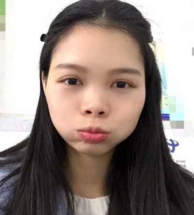 超声波去眼袋,带给我美丽!108 超声波去眼袋,带给我美丽!108