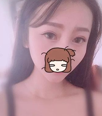 跟大家分享超声波双眼皮的经历吧978 跟大家分享超声波双眼皮的经历吧978
