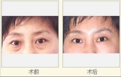 超 声 波去眼袋,不怕熬夜长眼袋 超 声 波去眼袋,不怕熬夜长眼袋