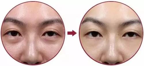 激光和超声波去眼袋手术有哪些不同516 激光和超声波去眼袋手术有哪些不同516