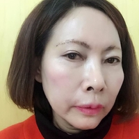 做了超声波祛眼袋真的年轻了不少524 做了超声波祛眼袋真的年轻了不少524