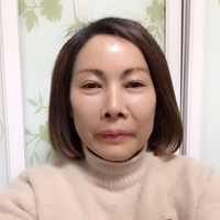 做了超声波祛眼袋真的年轻了不少524 做了超声波祛眼袋真的年轻了不少524