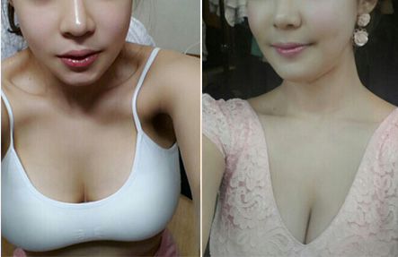 为le让乳房变大wǒ选择le自体脂肪丰胸 为le让乳房变大wǒ选择le自体脂肪丰胸