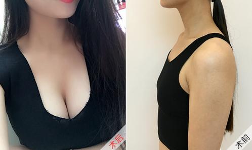 丰胸upup日记——超声波自体脂肪丰胸手术886 丰胸upup日记——超声波自体脂肪丰胸手术886