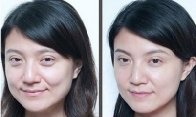 超 声 波去眼袋,效果真shì棒 超 声 波去眼袋,效果真shì棒