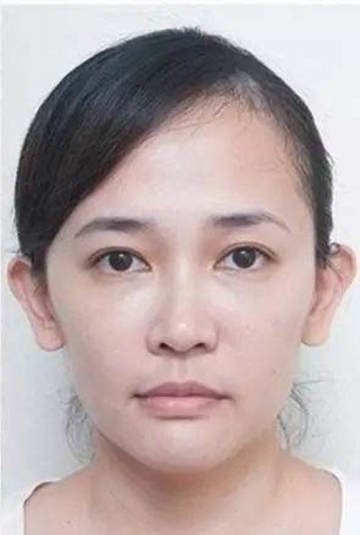 超声波去眼袋,完美的去掉眼袋309 超声波去眼袋,完美的去掉眼袋309