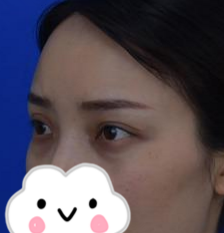 眼部修复我选择超声波双眼皮139 眼部修复我选择超声波双眼皮139
