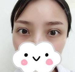 眼部修复我选择超声波双眼皮139 眼部修复我选择超声波双眼皮139