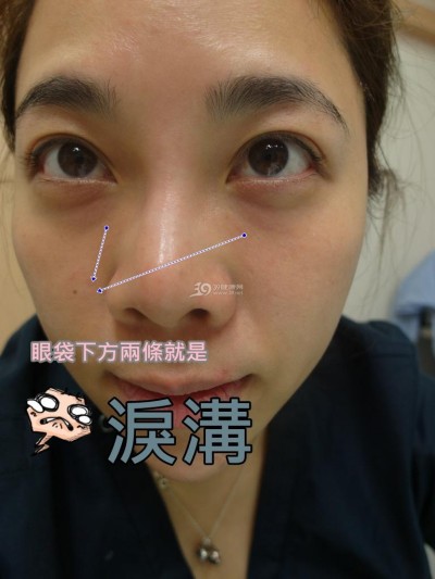 超声波去眼袋手术确实简单轻松750 超声波去眼袋手术确实简单轻松750