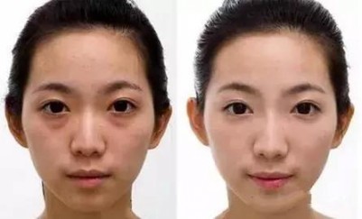 超声波去眼袋手术确实简单轻松750 超声波去眼袋手术确实简单轻松750