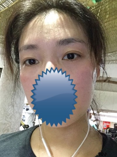 有着良好口碑得超 声 波去眼袋 有着良好口碑得超 声 波去眼袋
