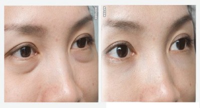 超声波去眼袋不一般的去眼袋技术985 超声波去眼袋不一般的去眼袋技术985