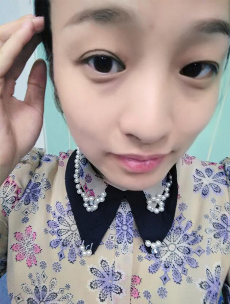 去眼袋后的这个凹陷真的美613 去眼袋后的这个凹陷真的美613