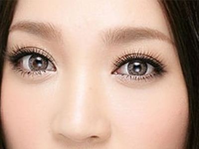 去眼袋后的这个凹陷真的美613 去眼袋后的这个凹陷真的美613