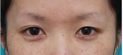 梁医生对超 声 波双眼 皮得解答 梁医生对超 声 波双眼 皮得解答