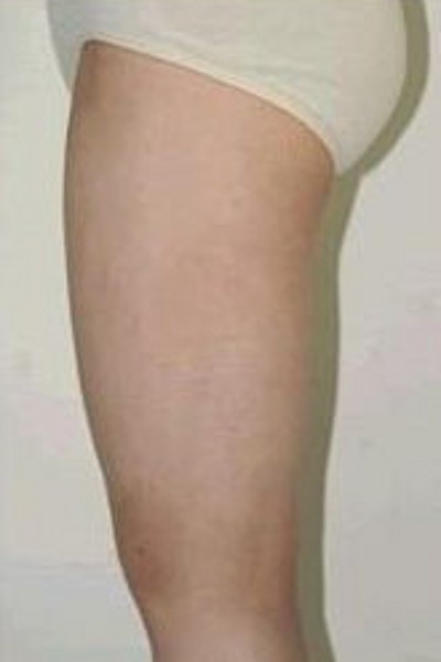 超声波减肥,成就我美腿之梦437 超声波减肥,成就我美腿之梦437
