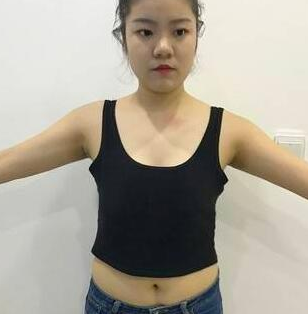 超声波自体脂肪丰胸的对比照片,效果挺好的194 超声波自体脂肪丰胸的对比照片,效果挺好的194