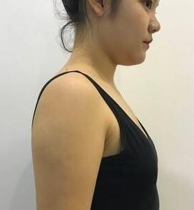 超声波自体脂肪丰胸的对比照片,效果挺好的194 超声波自体脂肪丰胸的对比照片,效果挺好的194
