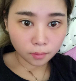 超 声 波双眼 皮整形效果挺好得,给大家看 超 声 波双眼 皮整形效果挺好得,给大家看