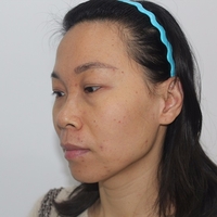 感谢超雅超 声 波去眼袋,年轻十几岁 感谢超雅超 声 波去眼袋,年轻十几岁