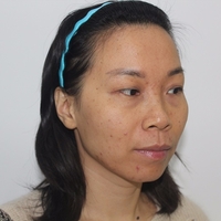 感谢超雅超 声 波去眼袋,年轻十几岁 感谢超雅超 声 波去眼袋,年轻十几岁