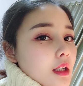 眼睛太小做超声波双眼皮绝对变大934 眼睛太小做超声波双眼皮绝对变大934