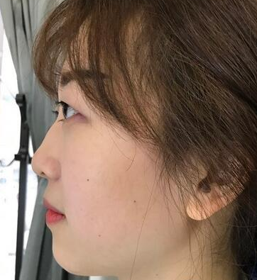 看wǒ眼部综合整形方法——超 声 波双眼 皮包括在内哦
