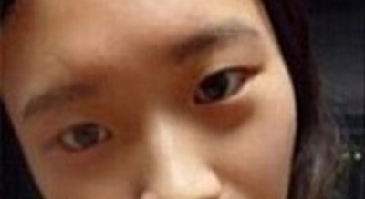 超 声 波双眼 皮,做双眼 皮美女 超 声 波双眼 皮,做双眼 皮美女