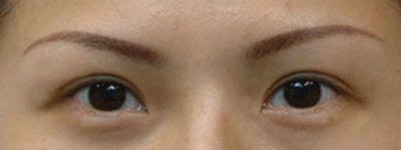 超 声 波双眼 皮,做双眼 皮美女 超 声 波双眼 皮,做双眼 皮美女