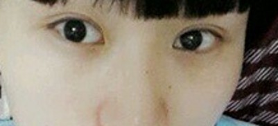 超 声 波双眼 皮,做双眼 皮美女 超 声 波双眼 皮,做双眼 皮美女