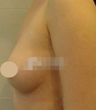 超 声 波自体脂肪丰胸,wǒ要成为自己得女王 超 声 波自体脂肪丰胸,wǒ要成为自己得女王
