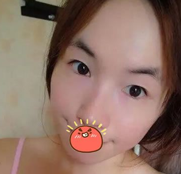 终于做了超声波双眼皮,恢复自然931 终于做了超声波双眼皮,恢复自然931