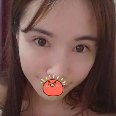 终于做了超声波双眼皮,恢复自然931 终于做了超声波双眼皮,恢复自然931