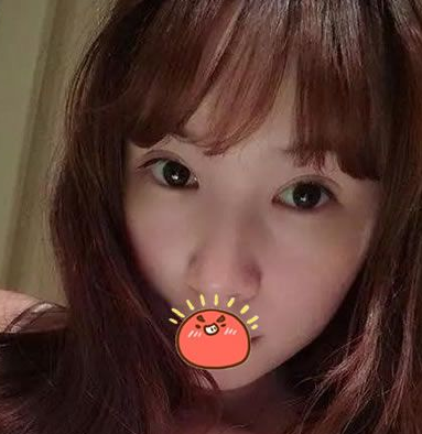 终于做了超声波双眼皮,恢复自然931 终于做了超声波双眼皮,恢复自然931