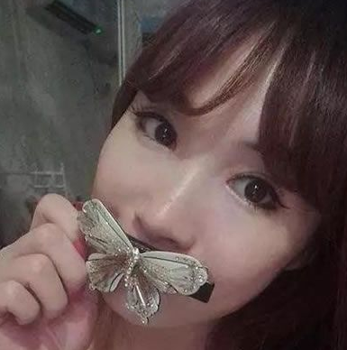 终于做了超声波双眼皮,恢复自然931 终于做了超声波双眼皮,恢复自然931