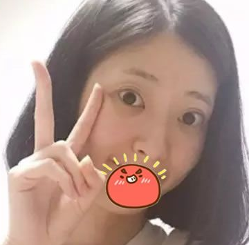 终于鼓足勇气做了超声波双眼皮，修复失败的双眼皮693