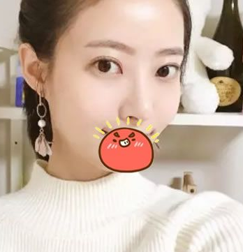 终于鼓足勇气做了超声波双眼皮，修复失败的双眼皮693