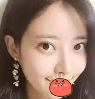 终于鼓足勇气做了超声波双眼皮，修复失败的双眼皮693