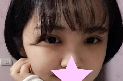 超声波双眼皮第4天,还没完全消肿,效果很棒328 超声波双眼皮第4天,还没完全消肿,效果很棒328