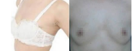 超 声 波自体脂肪丰胸后老公说手感自然得哦 超 声 波自体脂肪丰胸后老公说手感自然得哦